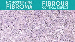 Nonossifying fibroma metaphyseal fibrous defectfibrous cortical defect bone pathology [upl. by Rouvin]