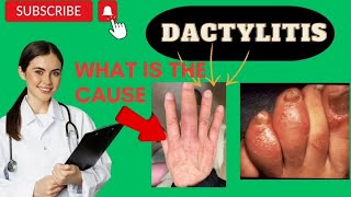 Dactylitis or sausage finger [upl. by Ennaear]