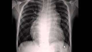 Chest xray  pulmonary arterial hypertension [upl. by Yekcir425]