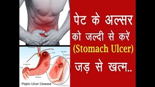 पेट के अल्सर को करें जड़ से ख़त्म Peptic Ulcer Treatment at Home [upl. by Angus559]