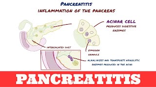 Pancreatitis [upl. by Florry440]