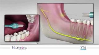 The Wand® STA Instrument  Inferior Alveolar mandibular Block [upl. by Nicodemus]