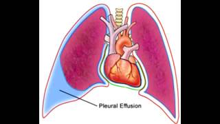 Pleural Effusions  Transudate Exudate amp Lymphatic [upl. by Marra]