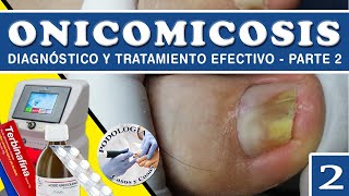 PARTE 2 ONICOMICOSIS  Diagnóstico y Tratamiento Efectivo  Podología Casos y Cosas [upl. by Yael]