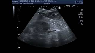 Right hydronephrosis and proximal hydroureter due to a calculus in the midureter [upl. by Aleik]