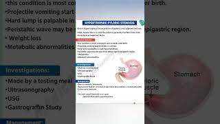 Pyloric stenosis [upl. by Lambertson922]