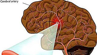 Intracerebral HemorrhageICHEtiology PathophysiologyClinical Features Diagnostic Treatment [upl. by Ives]