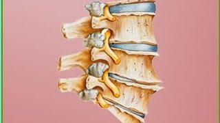 Is Degenerative Disc Disease Is Disease What is this Degenerative Disc Disease And what causes [upl. by Norod]