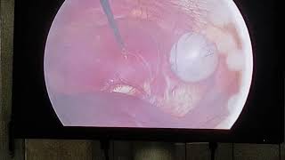 Laparoscopic Cholecystectomy [upl. by Burkle]