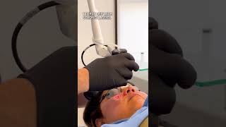 THIS Is How You Treat ACNE SCARS on Darker Skin 🙌 TCA CO2 Laser Erbium Laser Sculptra [upl. by Kissee]