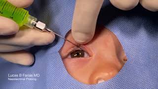 Probing of Nasolacrimal Duct with Fluorescein Irrigation [upl. by Idoux]