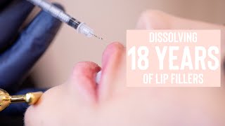 Dissolving 18 Years of Lip Fillers  The Vanity Lab [upl. by Adnuhs264]