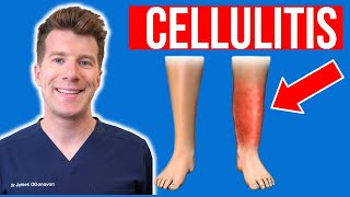 Doctor explains CELLULITIS skin infection  Causes symptoms treatment plus photos [upl. by Capps]