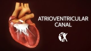 Atrioventricular Septal Defect  AV Canal [upl. by Branham]