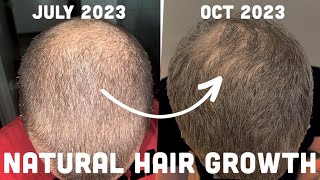 Regrow Your Hair Naturally No Finasteride No Minoxidil [upl. by Atirak]