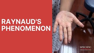 Raynauds Syndrome Phenomenon HELPED by Dr Suh Gonstead Chiropractic NYC [upl. by Gnaw111]