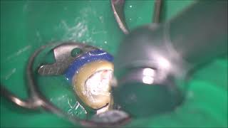 Sealer based obturation of Cshaped root canals in a retreatment case [upl. by Mandler978]