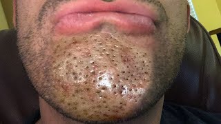 What Are Chin Pimples Ear Blackheads and Nose Whiteheads [upl. by Orsa298]