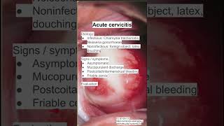 Acute cervicitis [upl. by Ahsinyar]