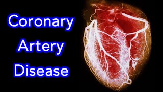 Coronary Artery Disease CAD Animation  MADE EASY [upl. by Yelhak287]