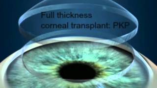 Full Thickness Corneal Transplantation Penetrating Keratoplasty PKP [upl. by Tipton]