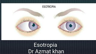 Esotropia its classifications and management Part 12 [upl. by Ylla]