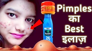 Pimples removal on face at home  How to Remove Pimple And pimple marks  पिंपल का इलाज [upl. by Ycrem]