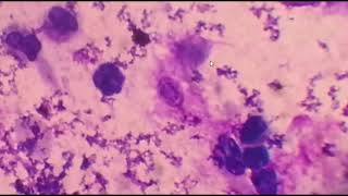 Pneumocystis pneumonia causative agent lab diagnosis and treatment [upl. by Duval]