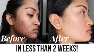 Acne Treatment Facial Peel  Before and After  SilasQiu [upl. by Reppiks97]