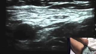 Ultrasound Guided Femoral Nerve Block  SSRAUSAcom [upl. by Annas]