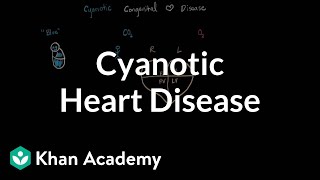 Step wise Approach to Cyanotic Congenital Heart Disease Dr Saurabh Gupta [upl. by Trini]