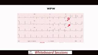 EDExam Whiteboard Session Dont Miss These ECGs Part 1 [upl. by Siraval]