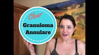 How my Granuloma Annulare Cleared Up [upl. by Elidad779]