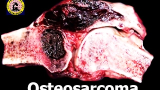 Osteosarcoma  Tumor de Hueso [upl. by Cirtemed]