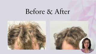 Natural Hair Loss Treatment for Men [upl. by Petite]