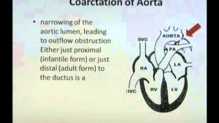 coarctation of the aorta [upl. by Torrance]