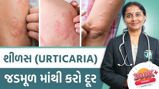 Ayurvedic Treatment Of Urticaria  Dr Devangi Jogal  JOGI Ayurved [upl. by Esalb]