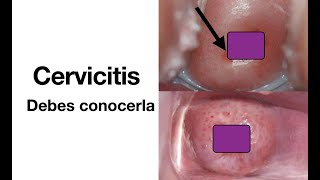 Cervicitis  Causas síntomas diagnóstico y tratamiento  ETS [upl. by Yelknirb]