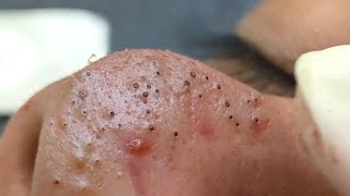 Suri Job 664 Awesome Inflamed Acne Extraction [upl. by Dorr]