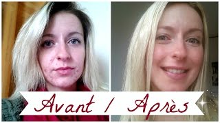 ACNE ❀ Roacutane mois après mois [upl. by Chance]