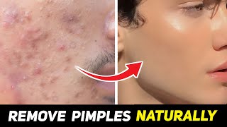 How to Remove PIMPLES From Face Naturally Acne Treatment  MR Fashion Zone [upl. by Hamitaf]