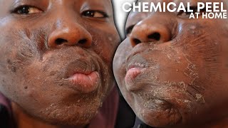 CHEMICAL PEEL FULL PROCESS AT HOME USING JESSNERS PEEL  BEFORE amp AFTER [upl. by Helve82]