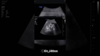 Staghorn calculus with renal mass amp mild dilatation of calyces of right kidney Sonography [upl. by Kinnie]