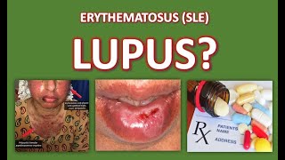 What is Lupus [upl. by Marciano]