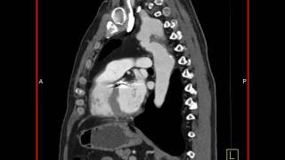 4D Imaging of the Aortic Valve Repaired coarctation of the aorta 2 of 3 [upl. by Irene883]