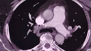 Pulmonary Embolism  CT scan [upl. by Sauls]