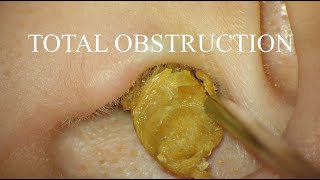 TOTAL OBSTRUCTION  EAR WAX REMOVAL  4KHD [upl. by Phene906]