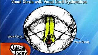 Vocal Cord Dysfunction [upl. by Demmahom21]