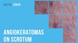 🙁 Angiokeratomas on scrotum [upl. by Eddana]