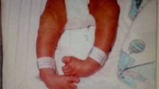 Ponseti Clubfoot  Joshua at 10 Years of Age long version [upl. by Silloh]